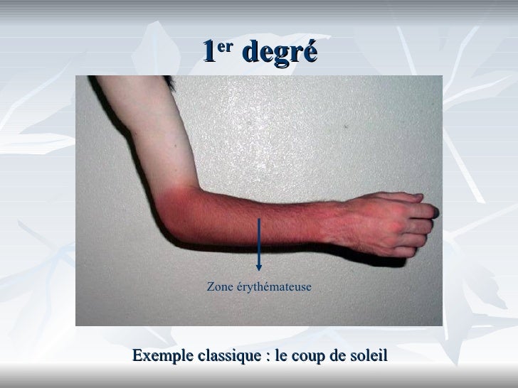 En savoir plus sur les brulures