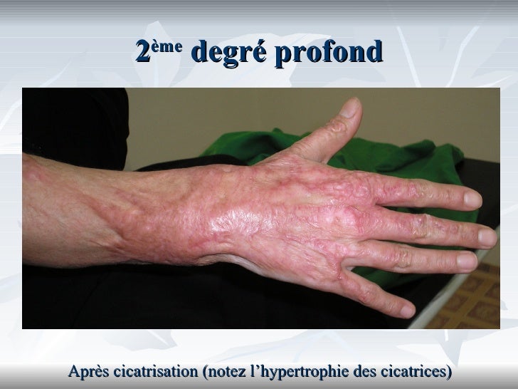 En savoir plus sur les brulures