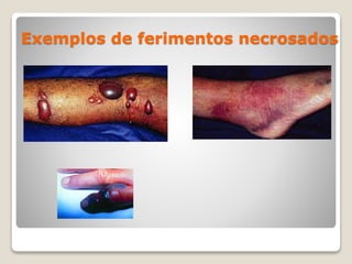 Exemplos de ferimentos necrosados
 