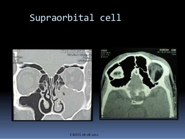 endoscopic anatomy of nasal cavity