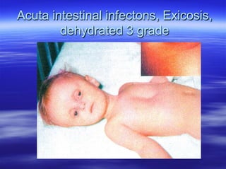 EN ACUTE INTESTINAL INFECTIONS OF CHILDREN2022 EN.pdf