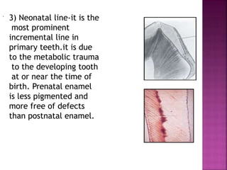  3) Neonatal line-it is the
most prominent
incremental line in
primary teeth.it is due
to the metabolic trauma
to the developing tooth
at or near the time of
birth. Prenatal enamel
is less pigmented and
more free of defects
than postnatal enamel.
 