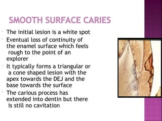  The initial lesion is a white spot
 Eventual loss of continuity of
the enamel surface which feels
rough to the point of an
explorer
 It typically forms a triangular or
a cone shaped lesion with the
apex towards the DEJ and the
base towards the surface
 The carious process has
extended into dentin but there
is still no cavitation
 