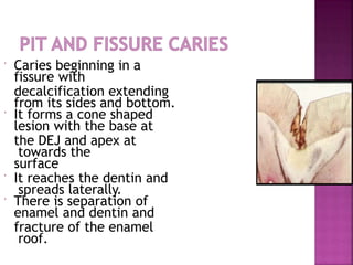  Caries beginning in a
fissure with
decalcification extending
from its sides and bottom.
 It forms a cone shaped
lesion with the base at
the DEJ and apex at
towards the
surface
 It reaches the dentin and
spreads laterally.
 There is separation of
enamel and dentin and
fracture of the enamel
roof.
 