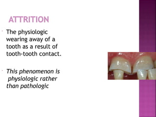  The physiologic
wearing away of a
tooth as a result of
tooth-tooth contact.
 This phenomenon is
physiologic rather
than pathologic
 
