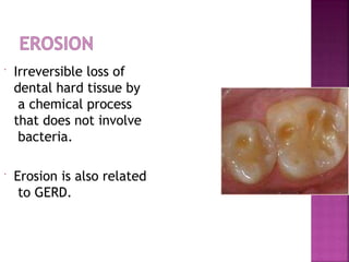 Irreversible loss of
dental hard tissue by
a chemical process
that does not involve
bacteria.
 Erosion is also related
to GERD.
 