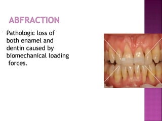  Pathologic loss of
both enamel and
dentin caused by
biomechanical loading
forces.
 