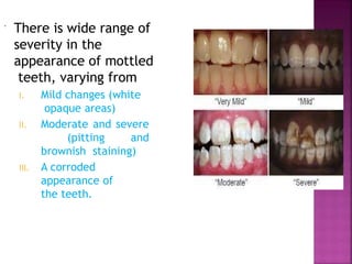  There is wide range of
severity in the
appearance of mottled
teeth, varying from
I. Mild changes (white
opaque areas)
II. Moderate and severe
(pitting and
brownish staining)
III. A corroded
appearance of
the teeth.
 