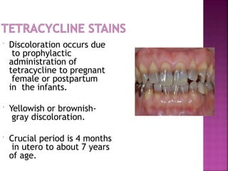  Discoloration occurs due
to prophylactic
administration of
tetracycline to pregnant
female or postpartum
in the infants.
 Yellowish or brownish-
gray discoloration.
 Crucial period is 4 months
in utero to about 7 years
of age.
 