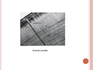 Enamel Lamella 