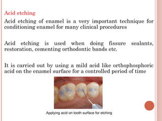 Acid etching Acid etching of enamel is a very important technique for conditioning enamel for many clinical procedures Acid etching is used when doing fissure sealants, restoration, cementing orthodontic bands etc. It is carried out by using a mild acid like orthophosphoric acid on the enamel surface for a controlled period of time Applying acid on tooth surface for etching 