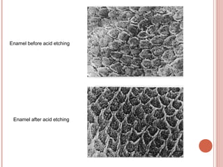 Enamel before acid etching Enamel after acid etching 
