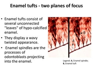 Enamel tufts - two planes of focus
• Enamel tufts consist of
several unconnected
"leaves" of hypo-calcified
enamel.
• They display a wavy
twisted appearance.
• Enamel spindles are the
processes of
odontoblasts projecting
into the enamel. Legend: A, Enamel spindle;
B, Enamel tuft
 