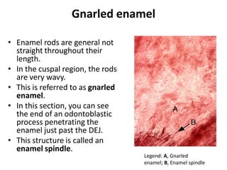 Gnarled enamel
• Enamel rods are general not
straight throughout their
length.
• In the cuspal region, the rods
are very wavy.
• This is referred to as gnarled
enamel.
• In this section, you can see
the end of an odontoblastic
process penetrating the
enamel just past the DEJ.
• This structure is called an
enamel spindle.
Legend: A, Gnarled
enamel; B, Enamel spindle
 