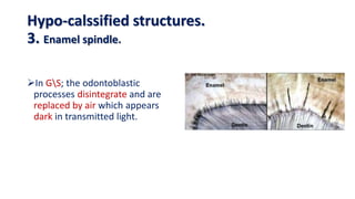 In GS; the odontoblastic
processes disintegrate and are
replaced by air which appears
dark in transmitted light.
Hypo-calssified structures.
3. Enamel spindle.
 