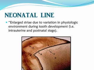 NEONATAL LINE
 “Enlarged striae due to variation in physiologic
environment during tooth development (i.e.
intrauterine and postnatal stage).
 