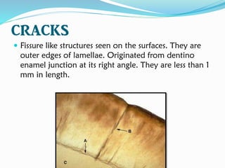CRACKS
 Fissure like structures seen on the surfaces. They are
outer edges of lamellae. Originated from dentino
enamel junction at its right angle. They are less than 1
mm in length.
 