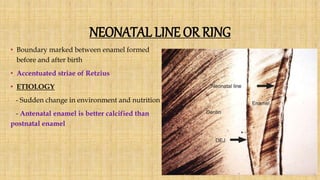 NEONATAL LINE OR RING
• Boundary marked between enamel formed
before and after birth
• Accentuated striae of Retzius
• ETIOLOGY
- Sudden change in environment and nutrition
- Antenatal enamel is better calcified than
postnatal enamel
 