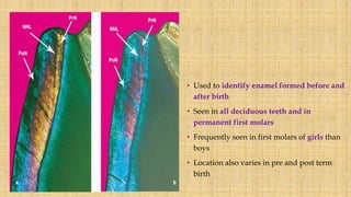 • Used to identify enamel formed before and
after birth
• Seen in all deciduous teeth and in
permanent first molars
• Frequently seen in first molars of girls than
boys
• Location also varies in pre and post term
birth
 