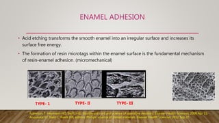 ENAMEL ADHESION
• Acid etching transforms the smooth enamel into an irregular surface and increases its
surface free energy.
• The formation of resin microtags within the enamel surface is the fundamental mechanism
of resin-enamel adhesion. (micromechanical)
TYPE- 1 TYPE- II TYPE- III
Roberson T, Heymann HO, Swift Jr EJ. Sturdevant's art and science of operative dentistry. Elsevier Health Sciences; 2006 Apr 13.
Anusavice KJ, Shen C, Rawls HR, editors. Phillips' science of dental materials. Elsevier Health Sciences; 2012 Sep 27.
 
