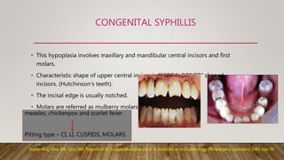 CONGENITAL SYPHILLIS
• This hypoplasia involves maxillary and mandibular central incisors and first
molars.
• Characteristic shape of upper central incisor is “SCREW-DRIVER” shaped
incisors. (Hutchinson’s teeth).
• The incisal edge is usually notched.
• Molars are referred as mulberry molars.
Shafer WG, Hine MK, Levy BM, Rajendran R, Sivapathasundharam B. A textbook of oral pathology. Philadelphia: Saunders; 1983 Sep 20.
measles, chickenpox and scarlet fever
Pitting type – CI, LI, CUSPIDS, MOLARS
 