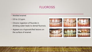 FLUOROSIS
• Mottled enamel
• 0.9 to 1.0 ppm.
• Chronic ingestion of fluoride in
drinking water leads to dental fluorosis.
• Appears as a hypocalcified lesions on
the surface of enamel.
Shafer WG, Hine MK, Levy BM, Rajendran R, Sivapathasundharam B. A textbook of oral pathology. Philadelphia: Saunders; 1983 Sep 20.
Peter S. Essentials of preventive and community dentistry. Arya (Medi) Publishing House; 2009.
 