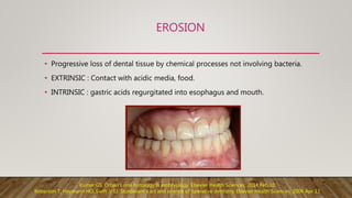 EROSION
• Progressive loss of dental tissue by chemical processes not involving bacteria.
• EXTRINSIC : Contact with acidic media, food.
• INTRINSIC : gastric acids regurgitated into esophagus and mouth.
Kumar GS. Orban's oral histology & embryology. Elsevier Health Sciences; 2014 Feb 10.
Roberson T, Heymann HO, Swift Jr EJ. Sturdevant's art and science of operative dentistry. Elsevier Health Sciences; 2006 Apr 13.
 