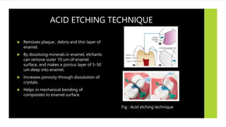 ACID ETCHING TECHNIQUE
 Removes plaque , debris and thin layer of
enamel.
 By dissolving minerals in enamel, etchants
can remove outer 10 um of enamel
surface, and makes a porous layer of 5-50
um deep into enamel.
 Increases porosity through dissolution of
crystals.
 Helps in mechanical bonding of
composites to enamel surface.
Fig : Acid etching technique
 