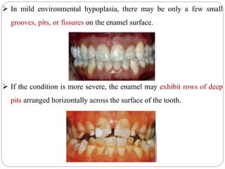  In mild environmental hypoplasia, there may be only a few small
grooves, pits, or fissures on the enamel surface.
 If the condition is more severe, the enamel may exhibit rows of deep
pits arranged horizontally across the surface of the tooth.
 