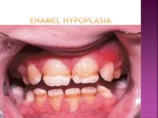 Enamel hypoplasia ppt