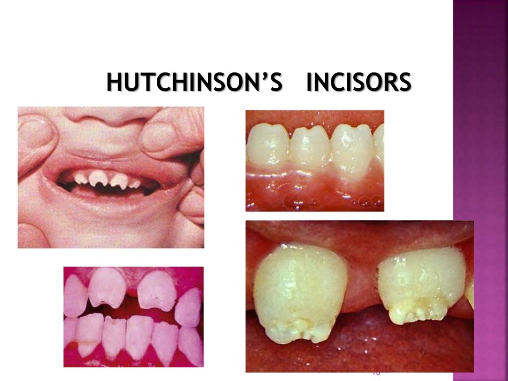 Enamel hypoplasia ppt