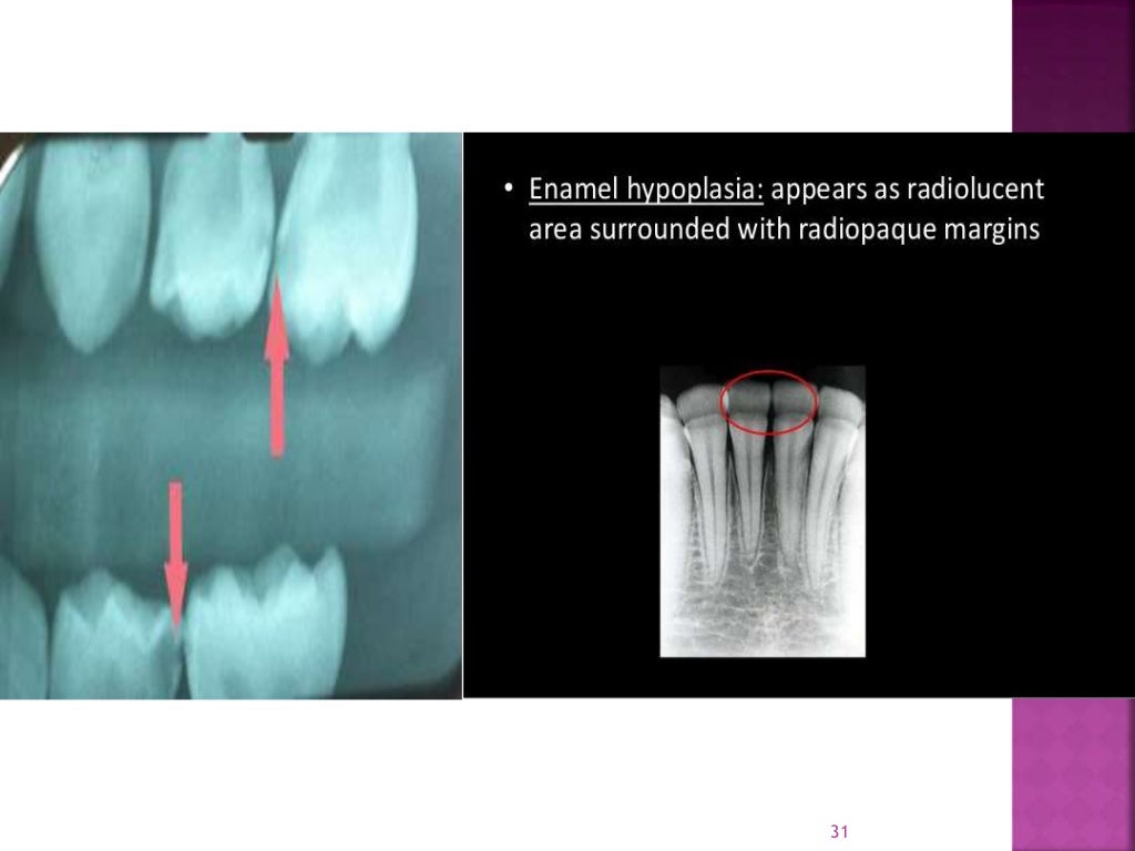 Enamel hypoplasia ppt