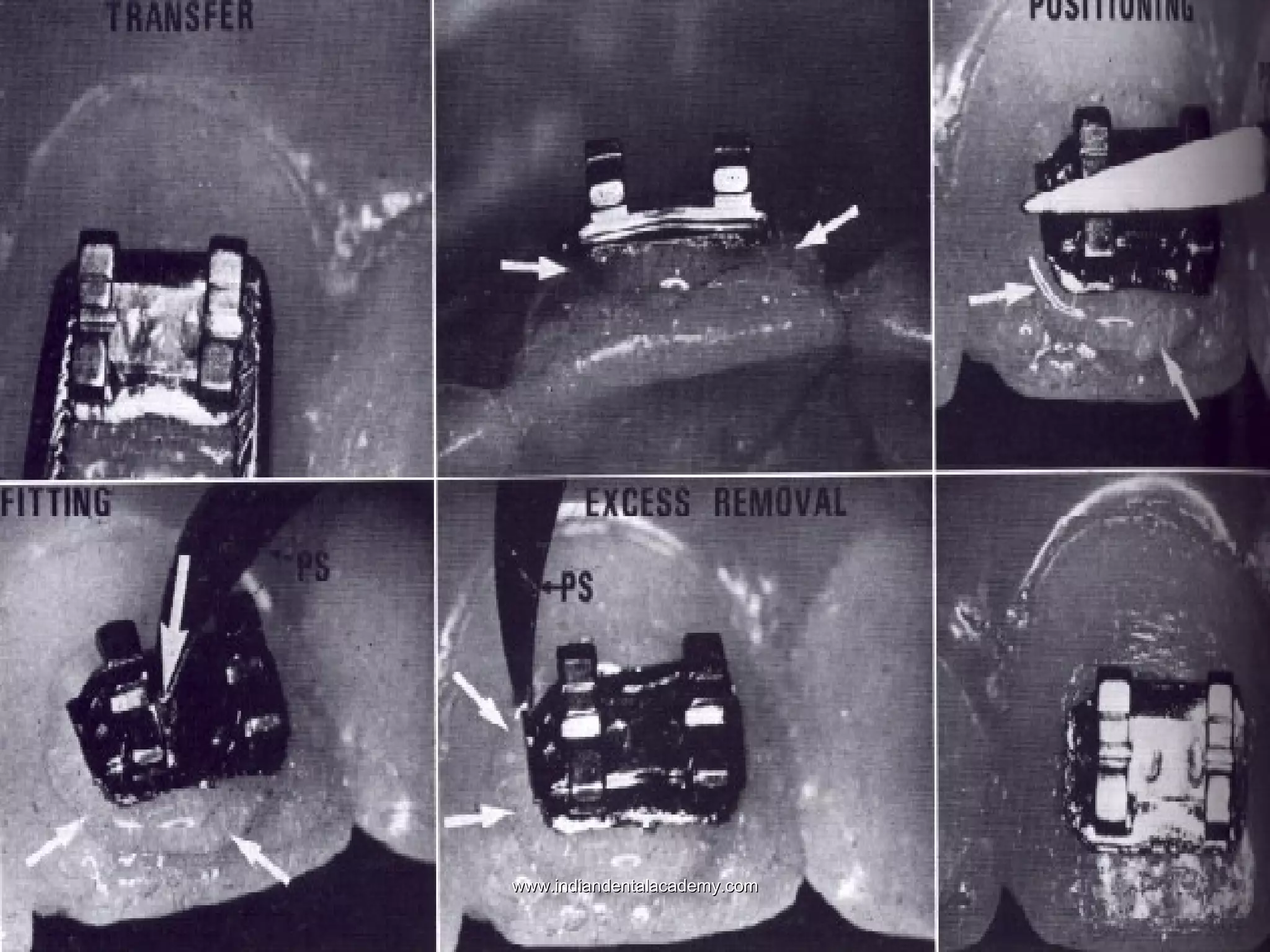  PremmiadAbdul WahabBOND PROCD.jpg

www.indiandentalacademy.com

 