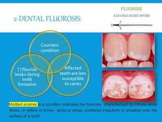 2-DENTAL FLUOROSIS:
Cosmetic
condition
Affected
teeth are less
susceptible
to caries
↑↑fluoride
intake during
tooth
formation
• Mottled enamel is a condition indicates the fluorosis characterized by minute white
flecks, or yellow or brown spots or areas, scattered irregularly or streaked over the
surface of a tooth
 