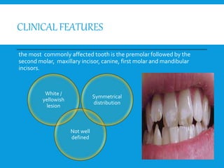 CLINICAL FEATURES
the most commonly affected tooth is the premolar followed by the
second molar, maxillary incisor, canine, first molar and mandibular
incisors.
White /
yellowish
lesion
Not well
defined
Symmetrical
distribution
 