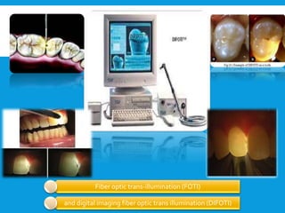 Fiber optic trans-illumination (FOTI)
and digital imaging fiber optic trans illumination (DIFOTI)
 