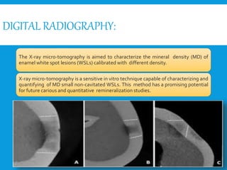 DIGITAL RADIOGRAPHY:
The X-ray micro-tomography is aimed to characterize the mineral density (MD) of
enamel white spot lesions (WSLs) calibrated with different density.
X-ray micro-tomography is a sensitive in vitro technique capable of characterizing and
quantifying of MD small non-cavitated WSLs. This method has a promising potential
for future carious and quantitative remineralization studies.
 