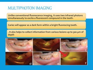 MULTIPHOTON IMAGING
Unlike conventional fluorescence imaging, it uses two infrared photons
simultaneously to excite a fluorescent compound in the tooth.
Caries will appear as a dark form within a bright fluorescing tooth.
. It also helps to collect information from carious lesions up to 500 μm of
depth
 