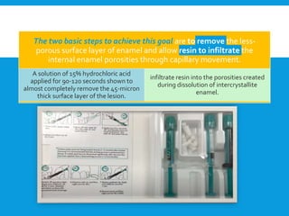 The two basic steps to achieve this goal are to remove the less-
porous surface layer of enamel and allow resin to infiltrate the
internal enamel porosities through capillary movement.
A solution of 15% hydrochloric acid
applied for 90-120 seconds shown to
almost completely remove the 45-micron
thick surface layer of the lesion.
infiltrate resin into the porosities created
during dissolution of intercrystallite
enamel.
 