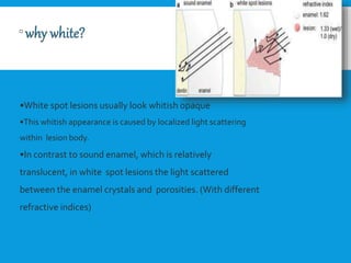 •White spot lesions usually look whitish opaque
•This whitish appearance is caused by localized light scattering
within lesion body.
•In contrast to sound enamel, which is relatively
translucent, in white spot lesions the light scattered
between the enamel crystals and porosities. (With different
refractive indices)
White Spot Lesions
 