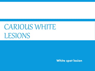 CARIOUS WHITE
LESIONS
White spot lesion
 