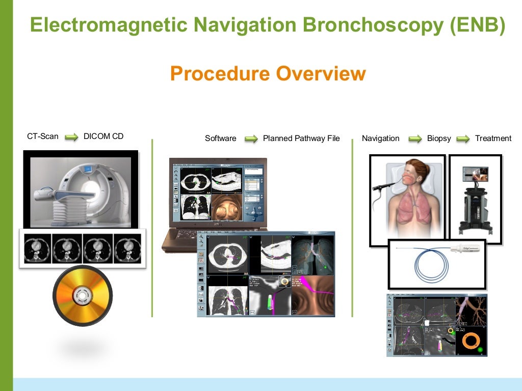 Navigation Bronchoscopy (ENB) Clinical Review