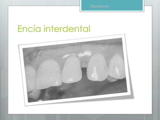Encía | PPTX