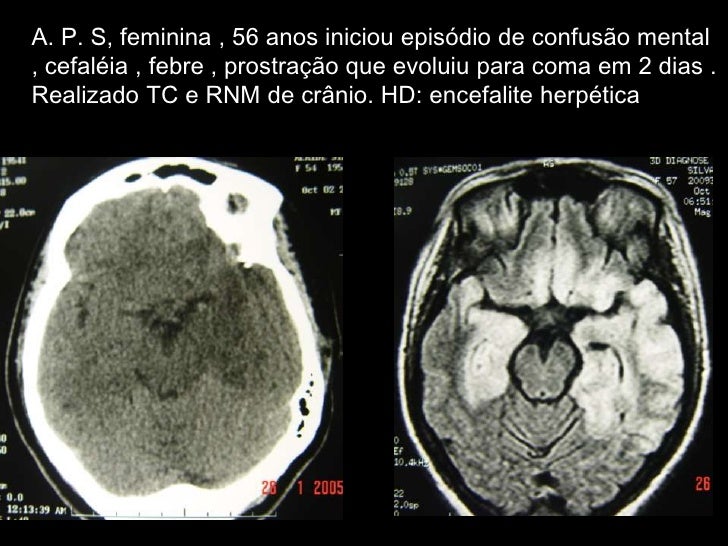 Encefalite herpética