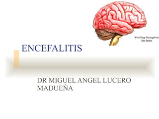 ENCEFALITIS DR MIGUEL ANGEL LUCERO MADUEÑA 