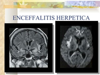 ENCEFFALITIS HERPETICA 