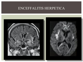 ENCEFFALITIS HERPETICA

 