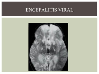 ENCEFALITIS VIRAL

 