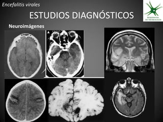 Encefalitis virales

             ESTUDIOS DIAGNÓSTICOS
   Neuroimágenes
 
