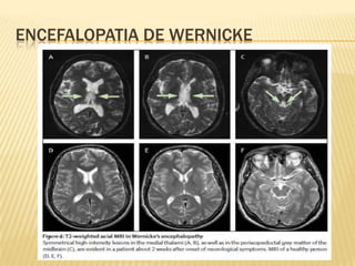 ENCEFALOPATIA DE WERNICKE
 